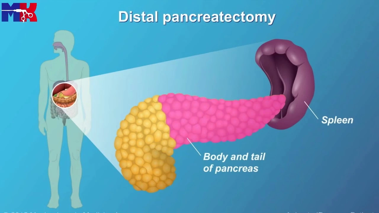 Pancreatic Cancer and Ethnicity: Understanding the Differences in Risk